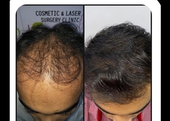 5 Best Hair transplant surgeons in Kolkata, WB 