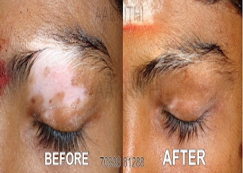 Aakrithi-skin-hair-clinic-Dermatologist-doctors-Dwaraka-nagar-vizag-Andhra-pradesh-2