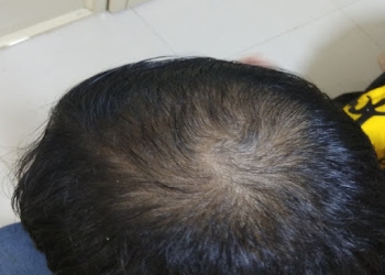 Al-ashhar-hair-clinic-Dermatologist-doctors-Gandhibagh-nagpur-Maharashtra-1