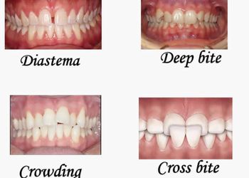 Kk-dental-care-Invisalign-treatment-clinic-Tiruppur-Tamil-nadu-3