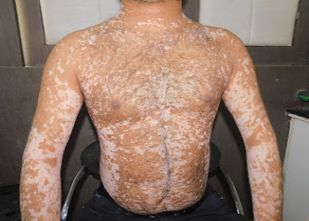 Maharshi-vitiligo-centre-nagpur-Dermatologist-doctors-Civil-lines-nagpur-Maharashtra-2