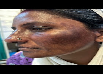 Sar-skin-hair-and-nail-care-Dermatologist-doctors-Purnia-Bihar-2