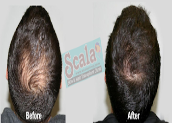 Scala-skin-hair-transplant-clinic-Dermatologist-doctors-Tirupati-Andhra-pradesh-2