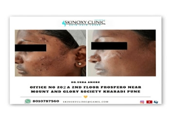 Skinoxy-skin-hair-clinic-by-dr-usha-Dermatologist-doctors-Kharadi-pune-Maharashtra-1